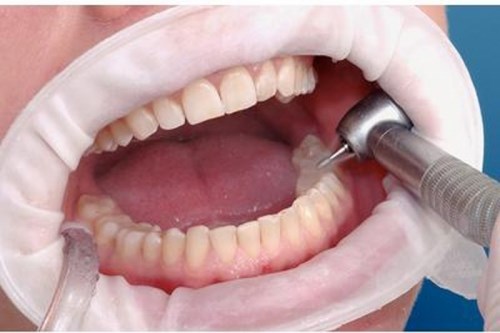 OptraGate  Regular стандартные, 1шт.,  Ivoclar. 123191086 - фото 329134