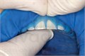 OptraDam Regular (1 шт.), Ivoclar 0001912339 - фото 329126