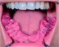 Futar D (2х50 мл, 6 нас.)-материал для регистрации прикуса, Kettenbach 1193211 00000000574 - фото 334996