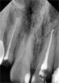 Радиовизиограф Rayence Vatech EzSensor размер 1.5 intraoral - фото 356214