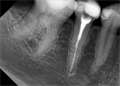 Радиовизиограф Rayence Vatech EzSensor размер 1.5 intraoral - фото 356216
