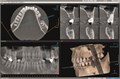Томограф Orthopantomograph KAVO 3D Pro Small Panel (6 x 4, 6 x 8). 0.805.5300 - фото 358010