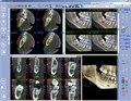 Томограф Planmeca ProMax 3D Plus без цефалостата 10032801 - фото 358024