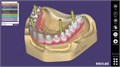 Модуль Exocad Implant module. Имплант модуль Implantmodule - фото 360984