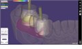 Модуль Exocad Implant module. Имплант модуль Implantmodule - фото 360985