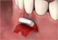 Fibro - Gide 20х40x6 мм, матрикс коллагеновый резорбируемый для аугментации мягких тканей, арт: 500234 500234 - фото 374119