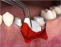 Fibro - Gide 20х40x6 мм, матрикс коллагеновый резорбируемый для аугментации мягких тканей, арт: 500234 500234 - фото 374120