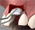 Fibro-Gide 15х20x6 мм, матрикс коллагеновый резорбируемый для аугментации мягких тканей 500239 / 500239 - фото 434565