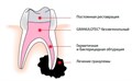 Granulotec 20 г+15 мл- Паста для постоянной обтурации инфицированных корневых каналов, PD 0001912350 - фото 455785