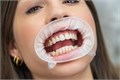 Роторасширитель OptraGate (Junior) Рефил 80 шт. - ретрактор для губ. 591451RU - фото 471192