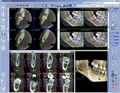 Томограф Planmeca ProMax 3Ds (FOV 9х8) 10020018 - фото 476741