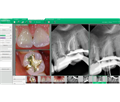 Vatech EzCam - проводная интраоральная камера 028853 - фото 495587
