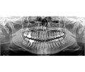 Carestream Dental CS 8100 3D - трехмерный томограф 020161 - фото 502421