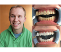Beyond Polus Whitening Accelerator - мультифункциональная комплексная система для профессионального отбеливания зубов PLS-868UL - фото 504014