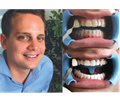 Beyond Polus Whitening Accelerator - мультифункциональная комплексная система для профессионального отбеливания зубов PLS-868UL - фото 504015