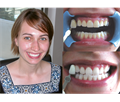 Beyond Polus Whitening Accelerator - мультифункциональная комплексная система для профессионального отбеливания зубов PLS-868UL - фото 504016