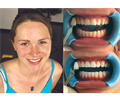 Beyond Polus Whitening Accelerator - мультифункциональная комплексная система для профессионального отбеливания зубов PLS-868UL - фото 504017