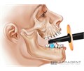 Ultradent VALO - проводная светодиодная фотополимеризационная лампа c тремя режимами полимеризации 5919 - фото 504071