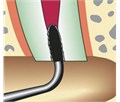 KaVo SONICflex retro - набор алмазных насадок со штопферами для щадящего препарирования ретроградных полостей 0.571.0381 - фото 504489