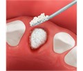 OsteoBiol Osteobiol Apatos Mix - гранулы из смеси губчатой и кортикальной кости без коллагена А1010FS - фото 504705